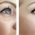 woman eye wrinkles before and after procedures